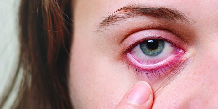 Under-eye Dark Circles: Causes and Treatment Tips