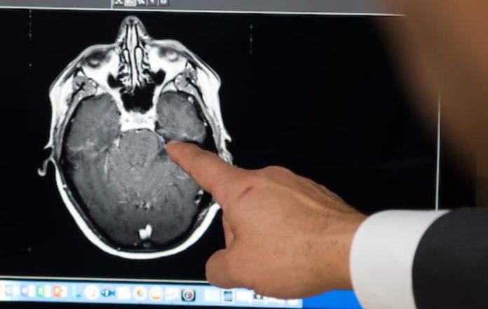 Early brain tumour diagnosis :Tips and prevention 