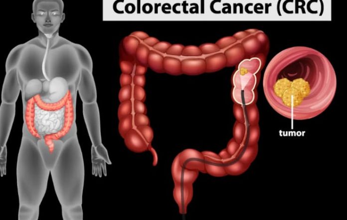 Colon Cancer Risk risking Young Adults: HERE'S WHAT YOU NEED TO KNOW