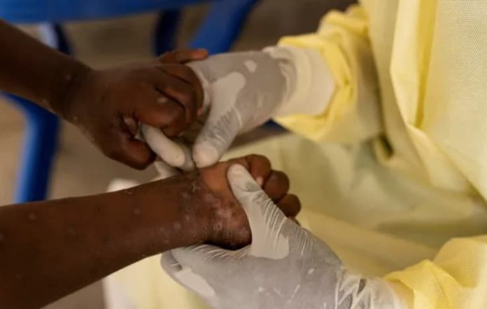 Monkeypox Cases on the Rise: Should You Be Concerned?