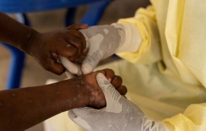 New Advisory Issued to States as Mpox Clade 1b Case Emerges