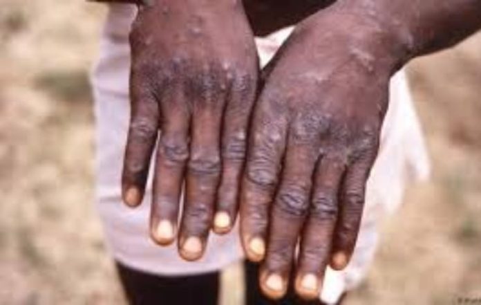 Why has WHO Declared Mpox Outbreak Global Health Emergency?